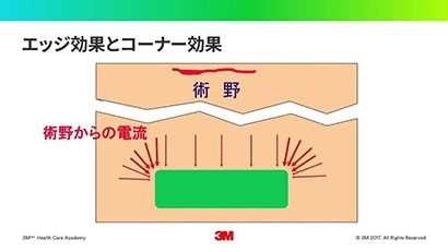 「電気メス手術における安全 ③ -対極板の安全性- 」
