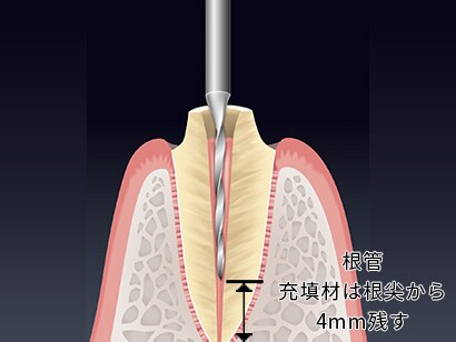 2.リライエックス™ ファイバーポスト ユニバーサルドリル、ピーソリーマー等を使用して根管充塡材を除去します。
