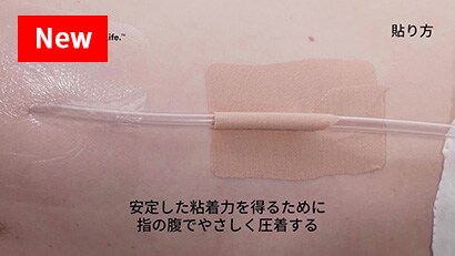 胸腔ドレーンの固定方法
