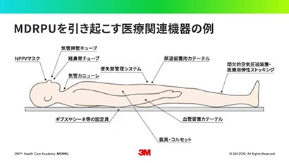 医療関連機器圧迫創傷（MDRPU）とは？
