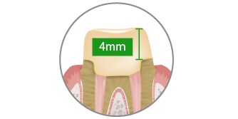 4mmの硬化深度
