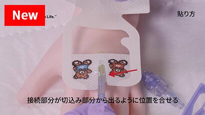 小児での末梢静脈カテーテルの固定動画
