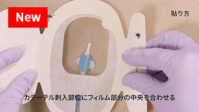 中心静脈カテーテルの固定
