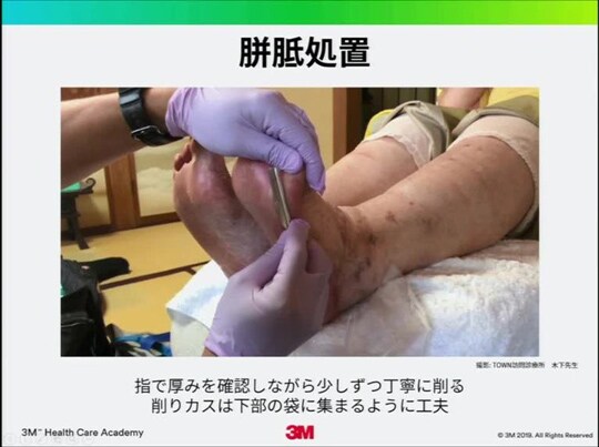 在宅の創傷治癒・ケア①-在宅での処置の実際
