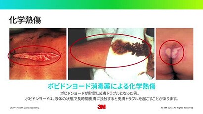 電気メス手術における安全 ② -電気手術における皮膚トラブルとその対策-
