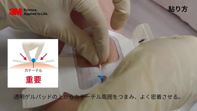 末梢静脈挿入式中心静脈カテーテル（PICC）の固定方法 ー3M™ テガダーム™ CHG ドレッシング（1660R）を使用ー
