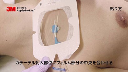 中心静脈カテーテルの固定２動画
