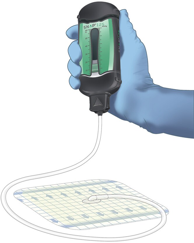 非電動型・単回使用局所陰圧閉鎖療法デバイス SNAP® 陰圧閉鎖療法システム
