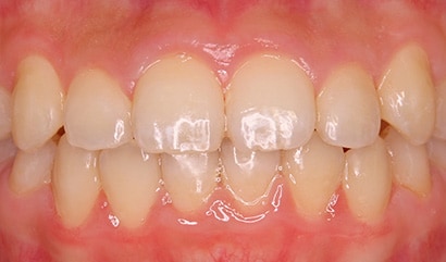 PMTC後の状態 STEP 4.
