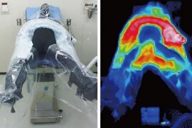 周術期低体温予防の取り組み～RALPにおける体温管理～