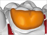 CAD/CAM技術を用いて、歯面に適合するブラケットパッドを設計。