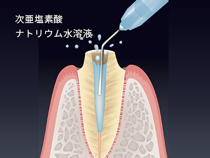 8.根管内を2.5～5.25%の次亜塩素酸ナトリウム水溶液を用いて清掃、消毒を行います。※過酸化水素水、その他の消毒剤、EDTAを含む溶液などを使用しないでください。
