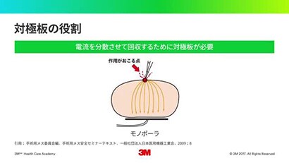 電気メス手術における安全 ① -電気手術の基礎-
