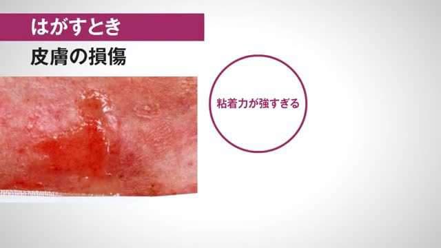 動画「かぶれの原因と対策」
