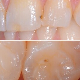2：気泡に起因する修復物の欠陥