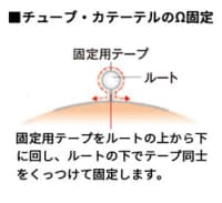 チューブ・カテーテルのΩ固定