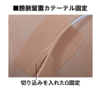 膀胱留置カテーテルチューブ固定