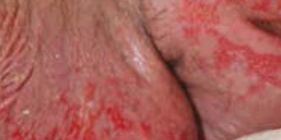 失禁関連皮膚炎(IAD) の皮膚保護に
