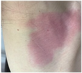 写真　皮膜剤を使わずにフィルム材を貼ると、健常皮膚でも剥がした後に発赤を起こすことがある