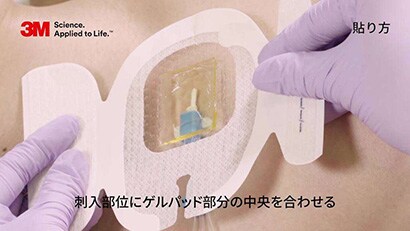 中心静脈カテーテルの固定（クロルヘキシジン含有ドレッシングを用いた例）動画
