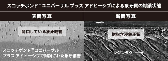 スコッチボンド™ ユニバーサル プラス アドヒーシブによる象牙質の封鎖状態