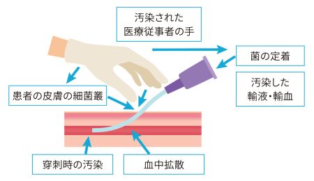 図2　 CLABSI発生の原因

