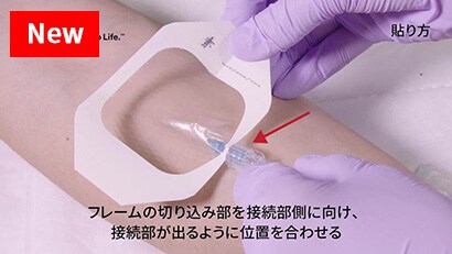 末梢静脈カテーテルの固定４動画
