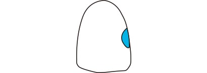 Ⅲ級窩洞
