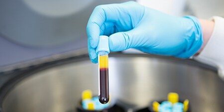 遠心分離機から取り出されたバイアルは、血漿が他の血液成分から分離されていることを示している。
