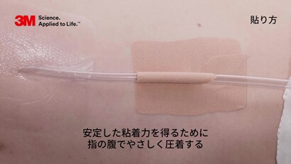 胸腔ドレーンの固定方法
