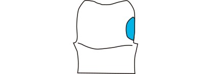 アンダーカットの埋め立て
