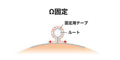 Ω（オメガ）固定