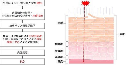IADの発生メカニズム 
