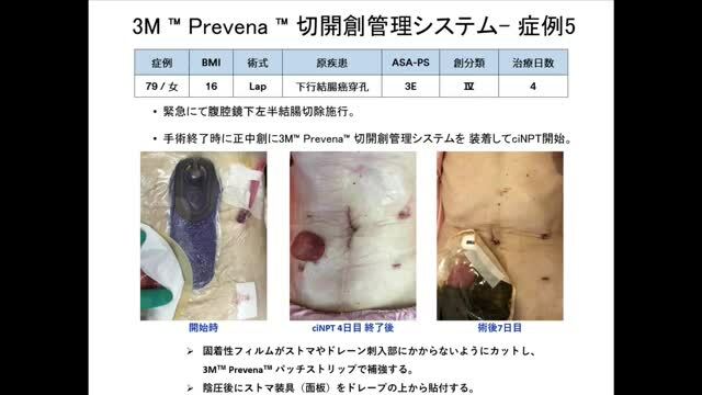 局所陰圧閉鎖療法による創傷管理、ファーストステップ「消化器外科領域におけるNPWTの活用と工夫」大阪警察病院 消化器外科（※講演収録当時）今里 光伸 先生