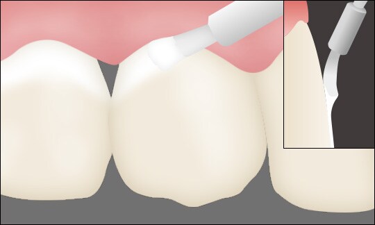 2. 必要量を採取し、アプリケーターブラシを用いて歯面に薄く塗布する。
