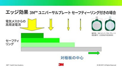 電気メス手術における安全 ③ -対極板の安全性-
