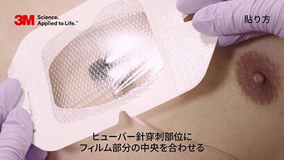 ヒューバー針の固定動画
