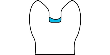 3：臼歯において隣接面窩洞の深さが咬合面で4 mmを超える場合または隣接部で5 mmを超える場合のベース・ライナーとして
