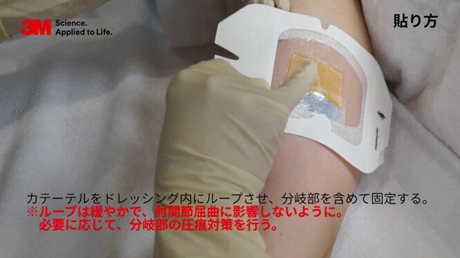 末梢静脈挿入式中心静脈カテーテル（PICC）の固定方法 ー3M™ テガダーム™ CHG ドレッシング（1658R）を使用ー
