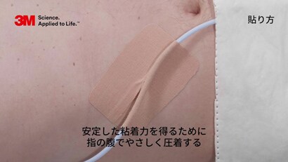 膀胱留置カテーテルの固定方法
