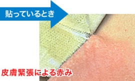 皮膚緊張による赤み