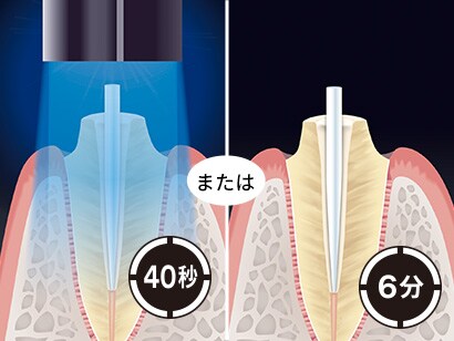 16.40秒光照射するか、もしくは化学重合で6分間硬化を待ちます。
