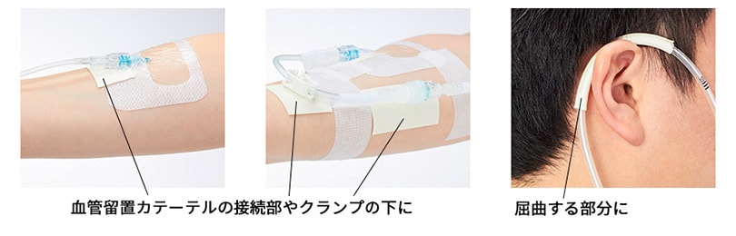 血管留置カテーテルの接続部やクランプの下に