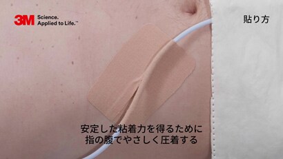 膀胱留置カテーテルの固定方法動画
