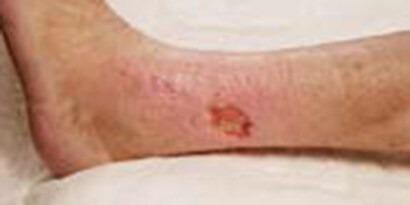 浮腫、下腿潰瘍等の周囲の健常皮膚の保湿と保護に 

