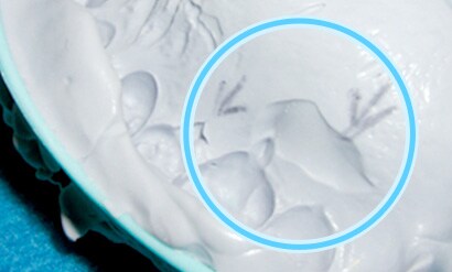 頬舌側でのフレアーの発生