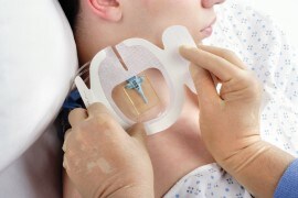 大量化学療法に合併するCRBSI対策　クロルヘキシジン含有ドレッシングによるCRBSI低減効果