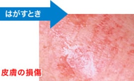 皮膚の損傷