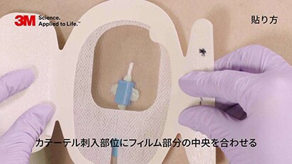 中心静脈カテーテルの固定
