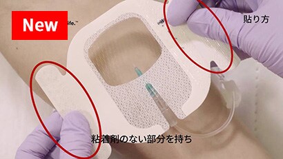 末梢静脈カテーテルの固定
